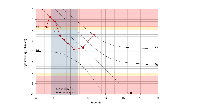 Eksempel på brystudvikling hos en pige diagnosticeret og behandlet for for tidilig pubertet